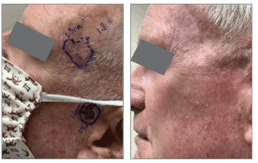 SCC and BCC Lesion Case Study