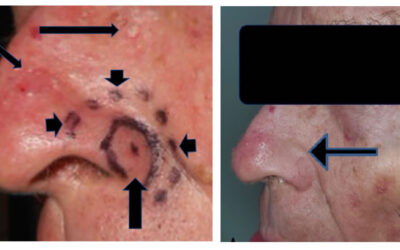 Radioterapia del cáncer de piel en paciente con mutación PTEN
