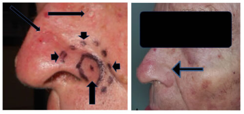 Radiotherapy of Skin Cancer in Patient with PTEN Mutation