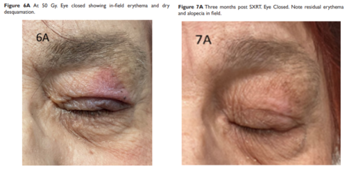 Radiotherapy for Eyelid Cancer