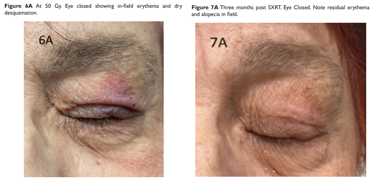 Radiotherapy For Eyelid Cancer Xstrahl 