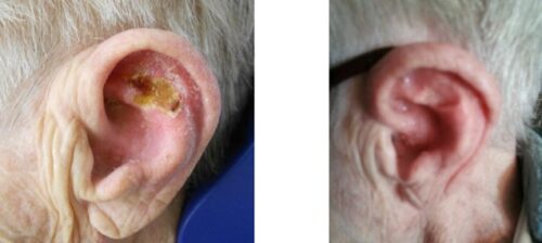 Electronic brachytherapy and superficial radiation therapy are excellent treatment options for patients with basal cell or squamous cell carcinomas
